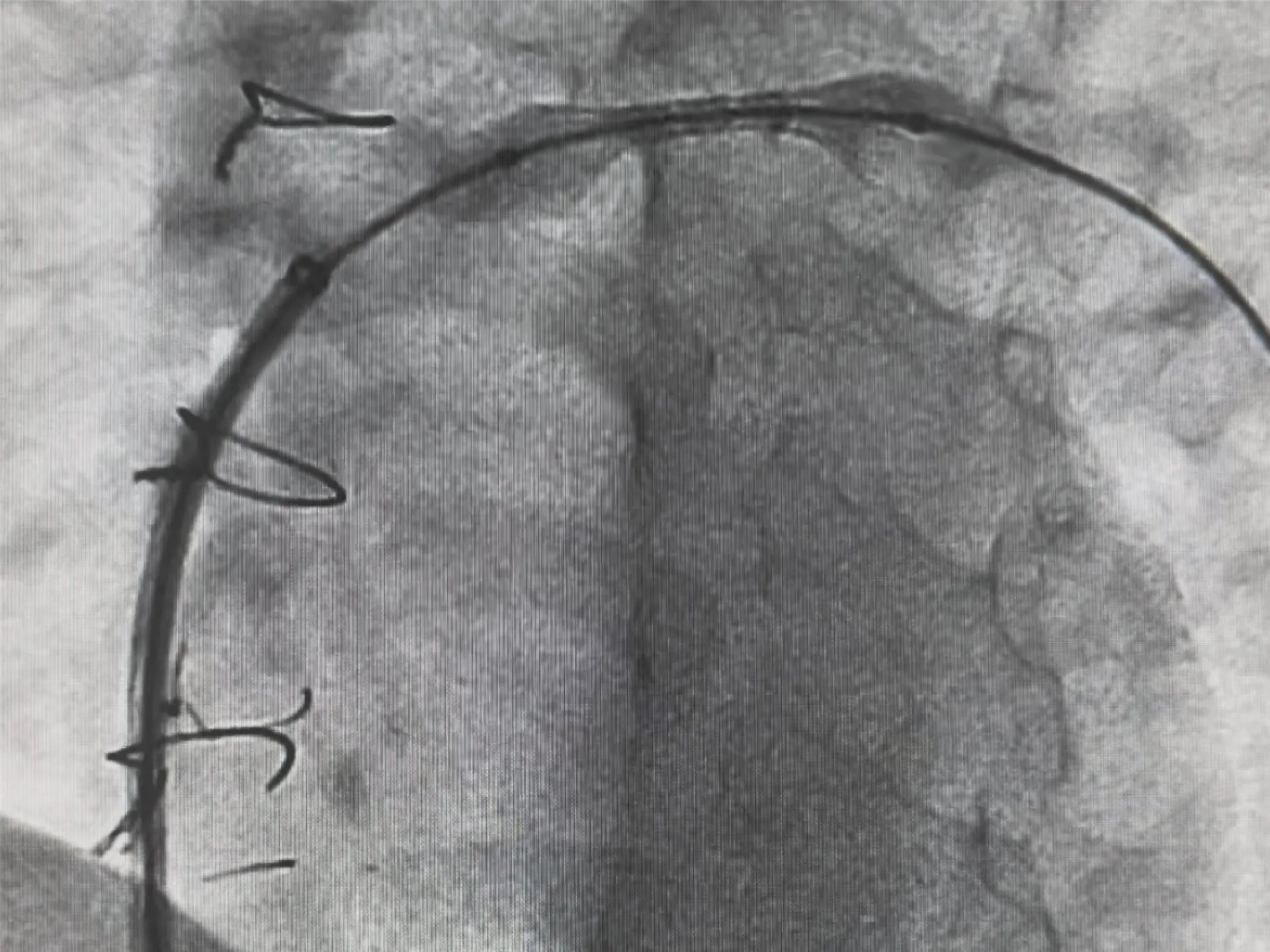 Girişimsel Kardiyoloji