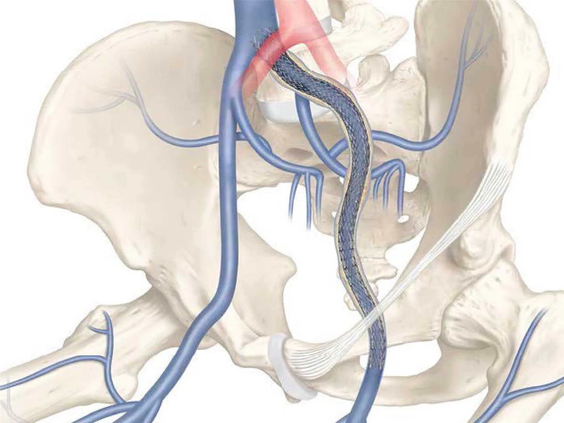 Girişimsel Radyoloji
